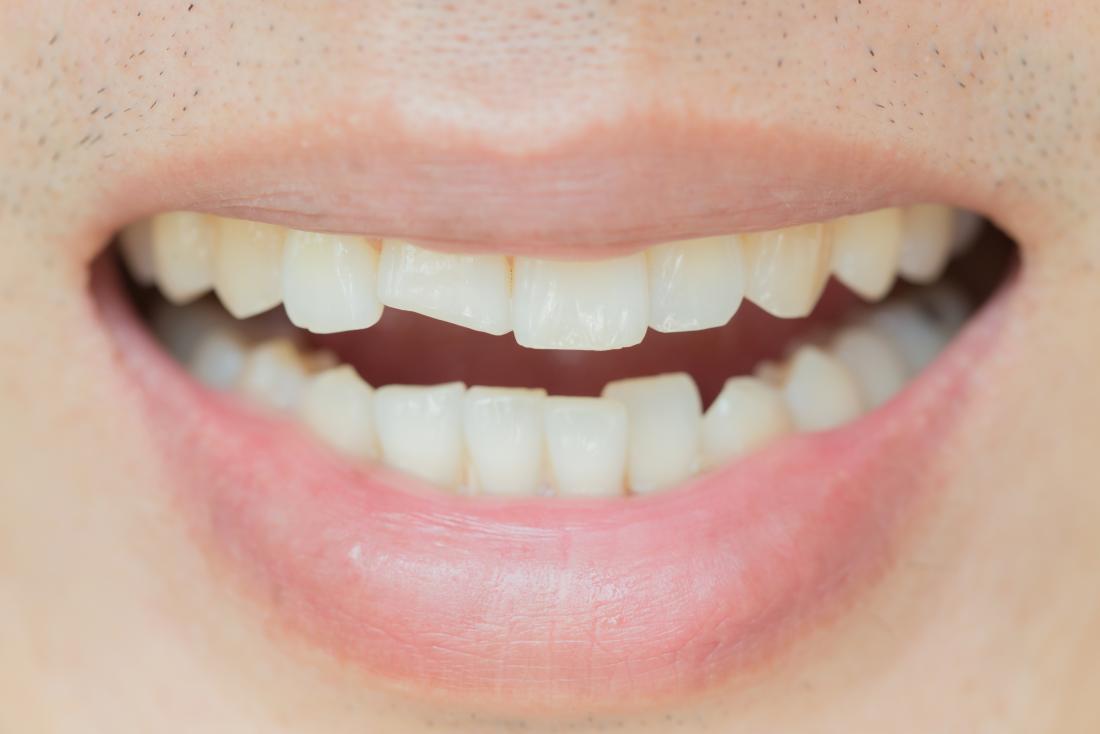 چرا دندان‌های خراب برای سلامتی مضر هستند